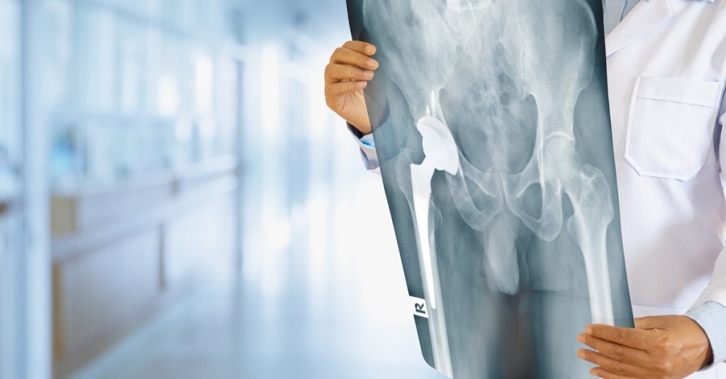 Academy Orthopedics are the very best at minimally invasive total hip replacement surgery.