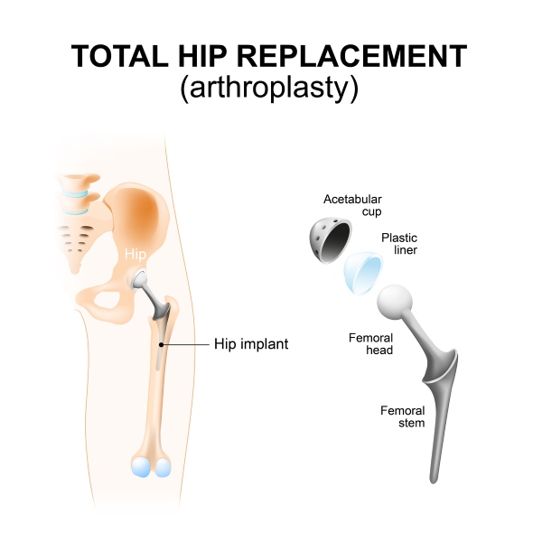 We'll give you a thorough evaluation to see if you're a candidate for a minimally invasive hip replacement. 