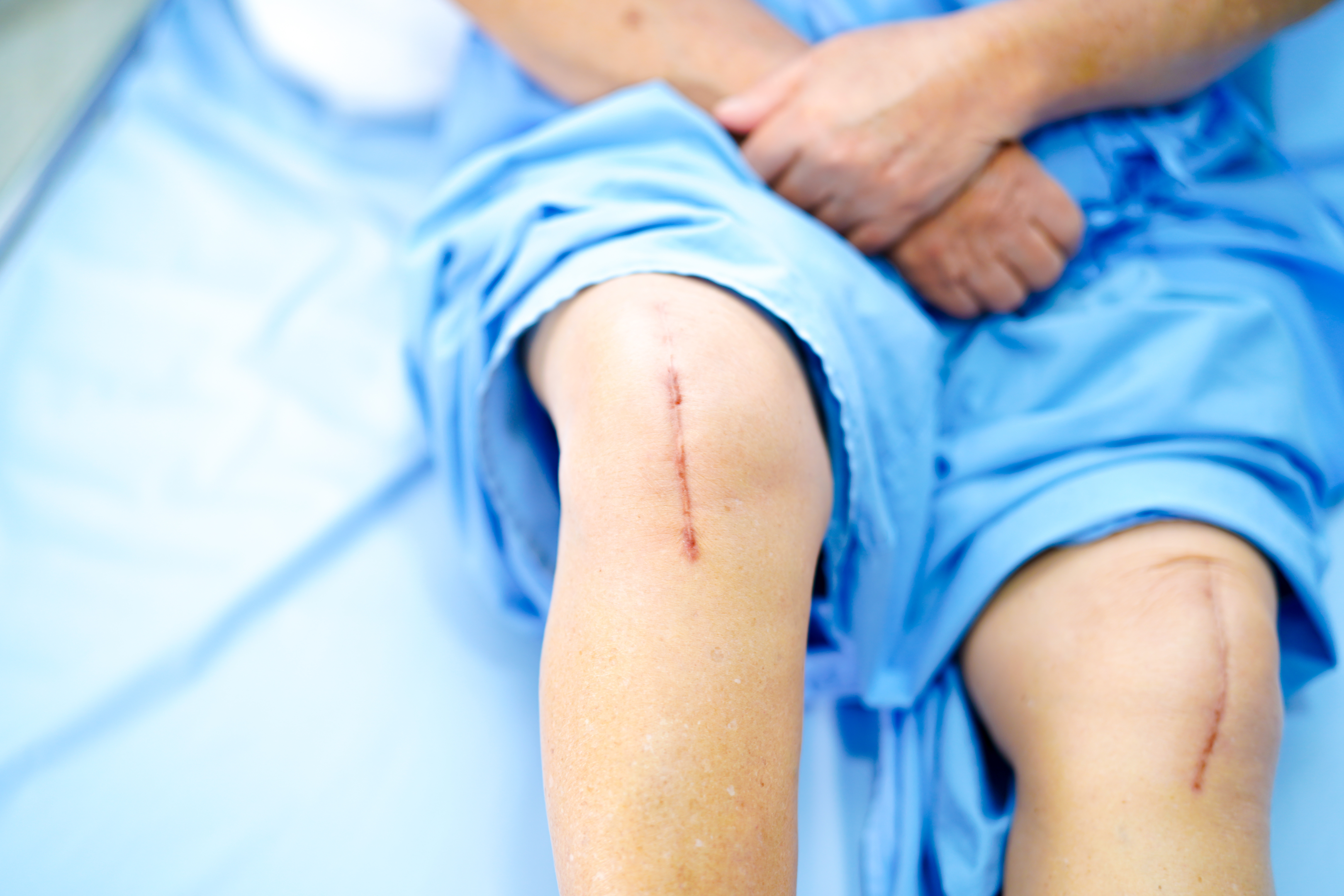 outpatient knee replacement