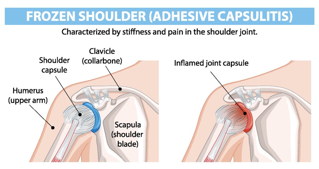 pain in the upper arm, shoulder blade, ball and socket joint, upper arm bone