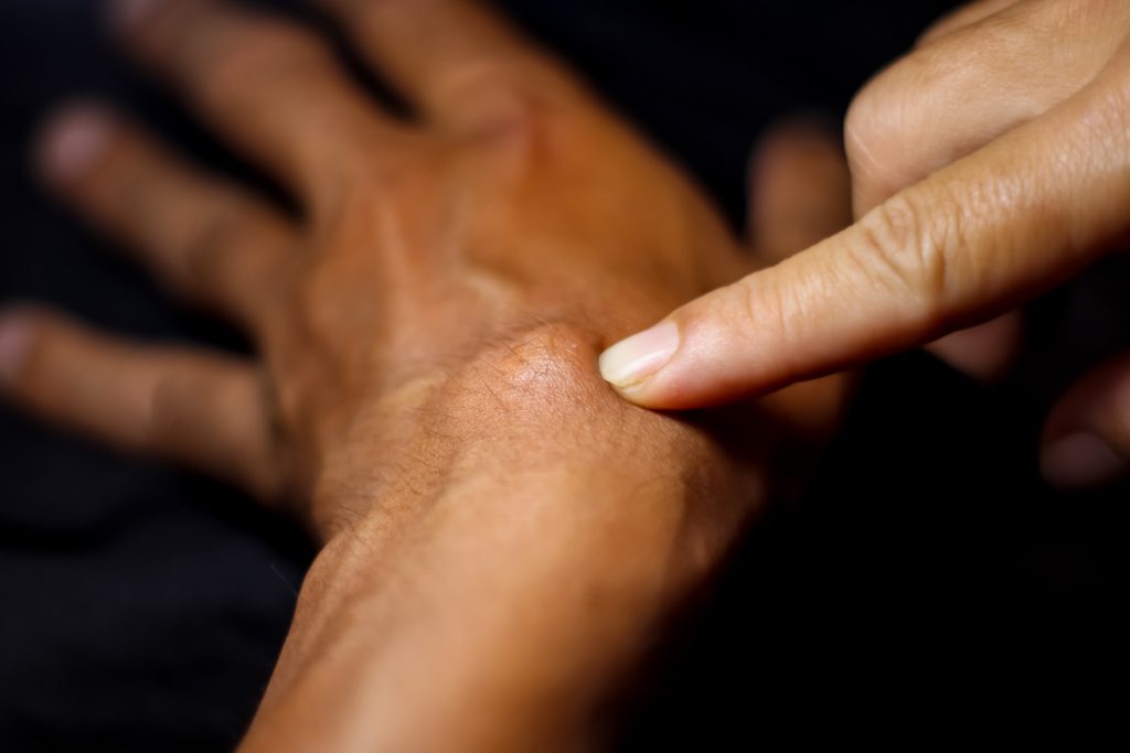 comprehensive guide to treating a ganglion cyst on your hand