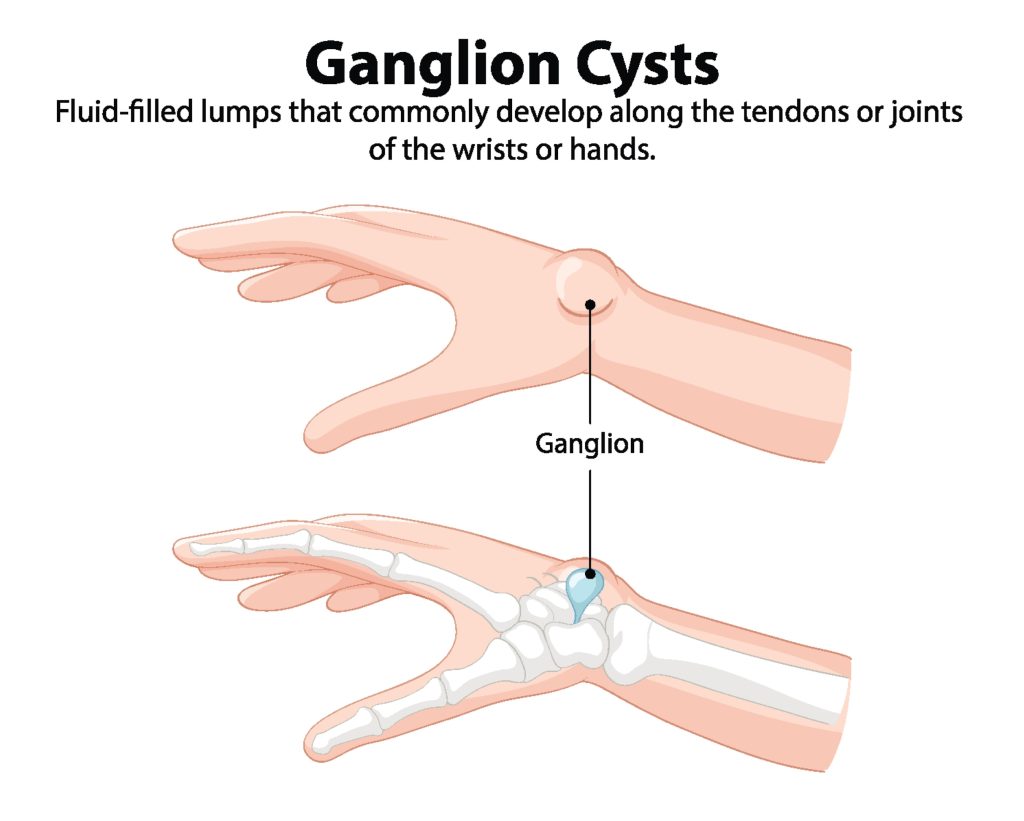 Ganglion Cysts