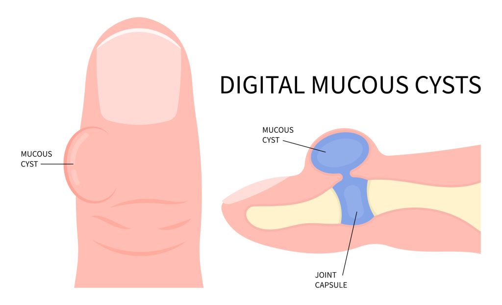 mucous cysts, connective tissue