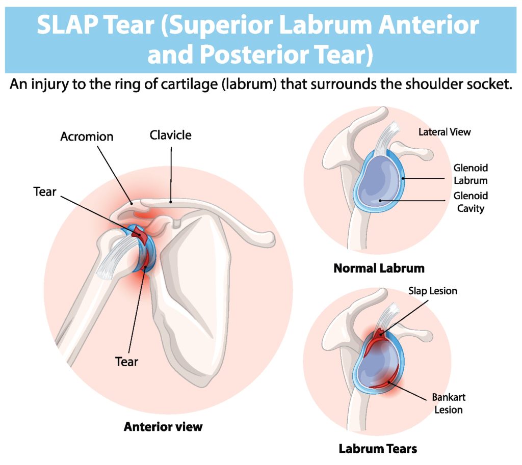 Understanding the Shoulder Labrum