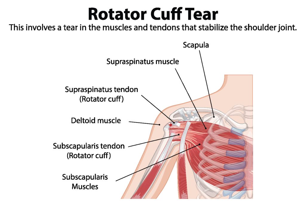 Understanding Rotator Cuff Tears