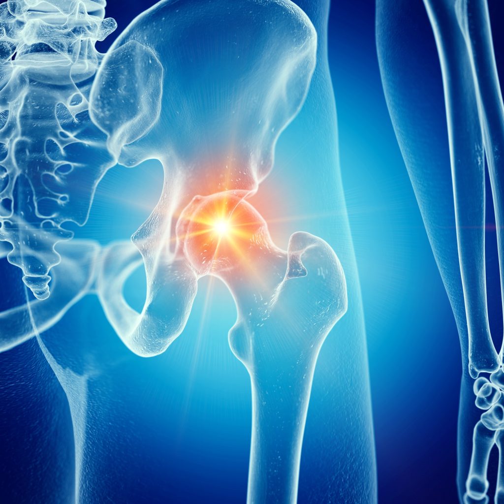 Hip Injuries: Fractures and Arthritis