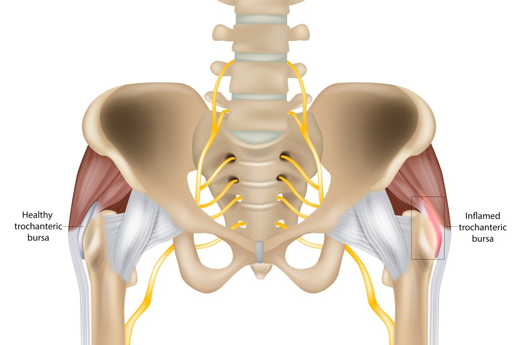 bursa trochanteric, hip muscles, hip bone