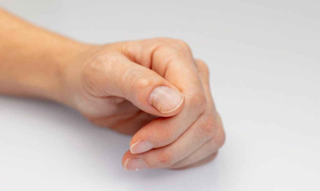 What's Causing That Lump Near Your Fingernail